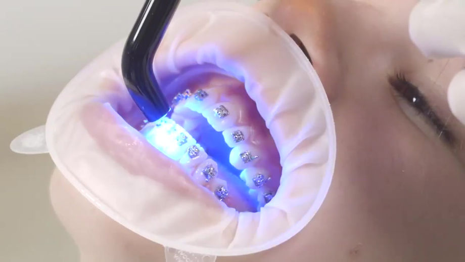 Carriere® SLX™ Self Ligating Bracket System